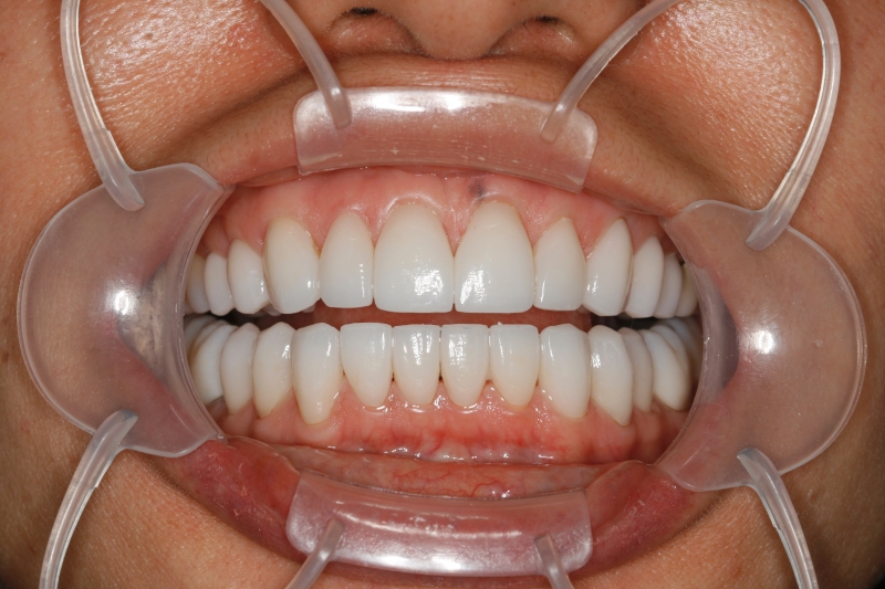 Did you know that TMJ problems can cause Cosmetic Dentistry problems